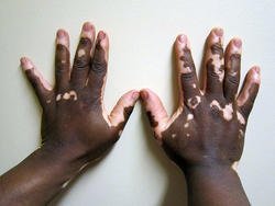 vitiligo2_800_medium