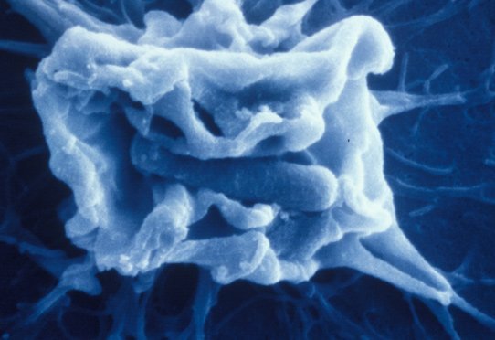 Foyer d'entrée de shigella dans une cellule épithéliale. Cette bactérie envahit et détruit la muqueuse intestinale du côlon provoquant chez l'homme une dysenterie.