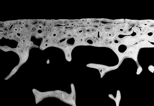 Microrradiografía de una sección de tejido óseo humano que ilustra la heterogeneidad de la mineralización ósea (áreas grises oscuras ligeramente mineralizadas y áreas blancas más mineralizadas).