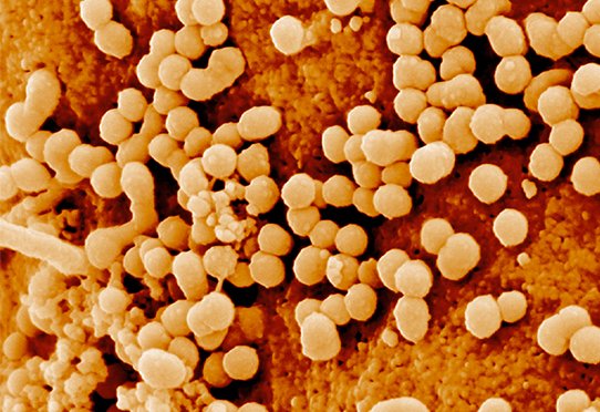 Cellule infectée par le virus de l'immunodéficience humaine (VIH) examinée en microscopie électronique à balayage (MEB)