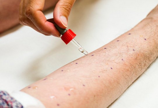 Test allergologique cutané sur un patient asthmatique à l'institut du Thorax, hôpital Laennec, Nantes.
