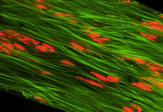 Trabéculum glaucomateux : raréfaction majeure des cellules trabéculaires (iodure de propidium). La coloration verte est due à l’autofluorescence de l’élastine constitutive des mailles trabéculaires.
