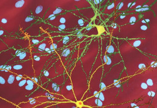 Montage de trois images de neurones striatauxn simples transfectés avec une version associée à la maladie de la huntingtine, la protéie qui cause la maladie de Huntington. Des noyaux de neurones non transfectés sont visibles en arrière-plan (en bleu). Le neurone au centre (jaune) contient une accumulation intracellulaire anormale de huntingtine appelée corps d'inclusion (orange).