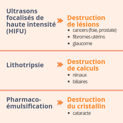 Utilisations thérapeutiques des ultrasons (HIFU), Lithotripsie, Pharmacoémulsification