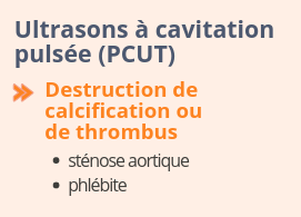 Ultrasons à cavotation pulsée - destruction de calcification et de thrombus