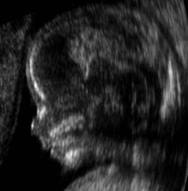 Foetus de 14 semaines