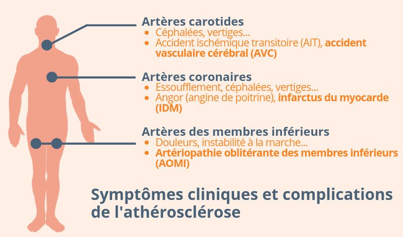 Symptômes cliniques et complications de l'athérosclérose. Accident vasculaire cérébral (AVC), Infarctus du myocarde (IDM), Arthériopathie oblitérante des membres inférieurs (AOMI)