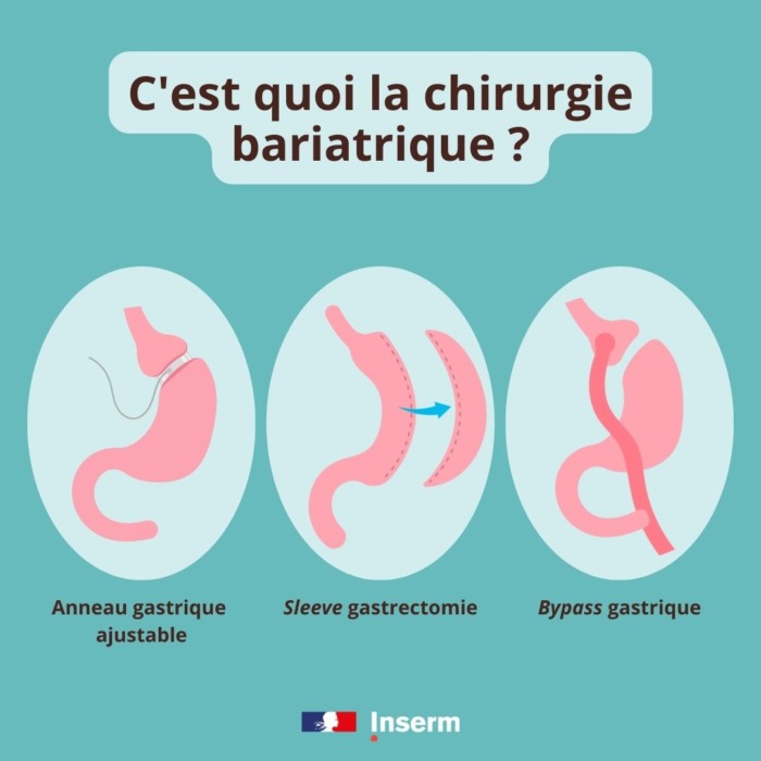 Couper-caler – C’est quoi la chirurgie bariatrique ? · Inserm, La ...