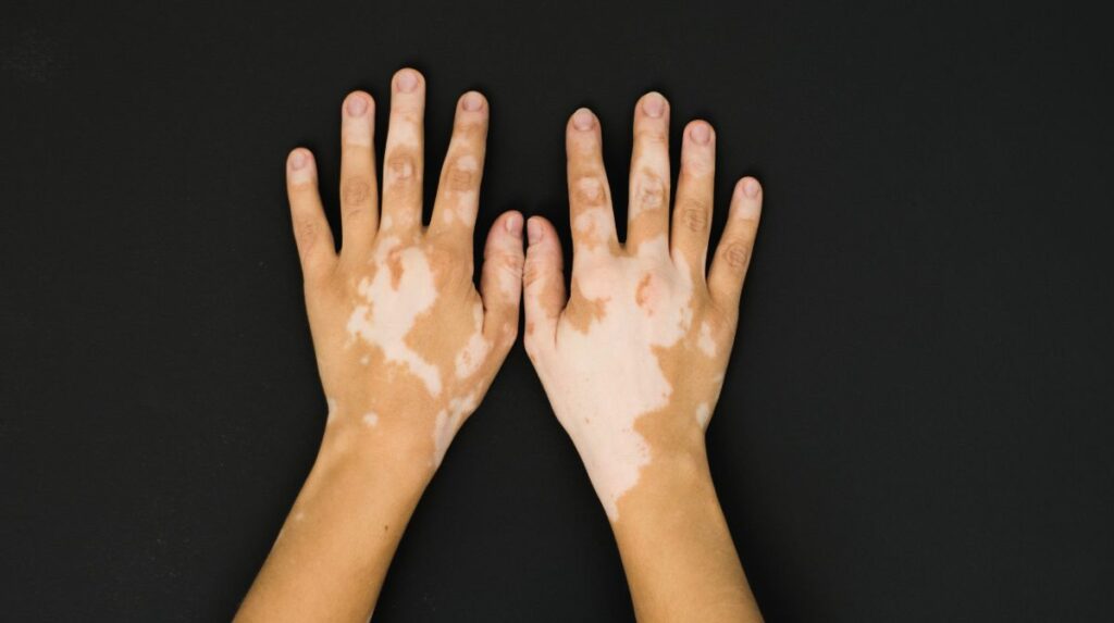 Vitiligo · Inserm, La science pour la santé