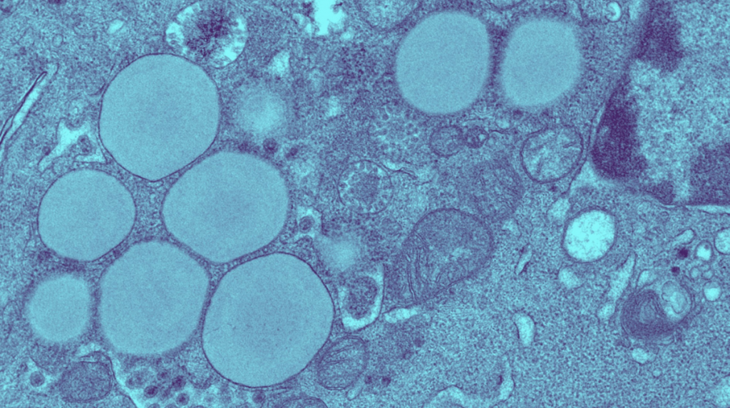 Des cellules infectées par le virus de l'hépatite C accumulent de grosses gouttelettes lipidiques, un phénomène appelé stéatose qui contribue au développement d'une fibrose du foie.