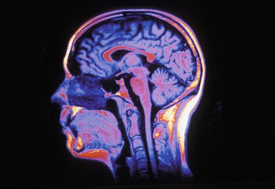 Cerveau humain en IRM, coupe sagittale
