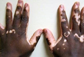 [2015-02-24] INFRv4_e-cadhérine, vitiligo_IAU.jpg