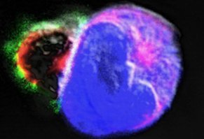 [2016-03-24] INFRv4_mélanomes, lymphocytes_IAU.jpg