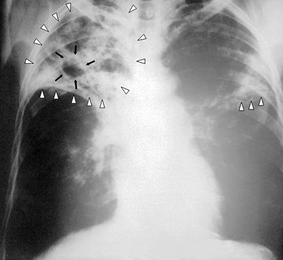 Radiographie des poumons d'un patient atteint d'une tuberculose pulmonaire bilatérale. © Centers for Disease Control and Prevention