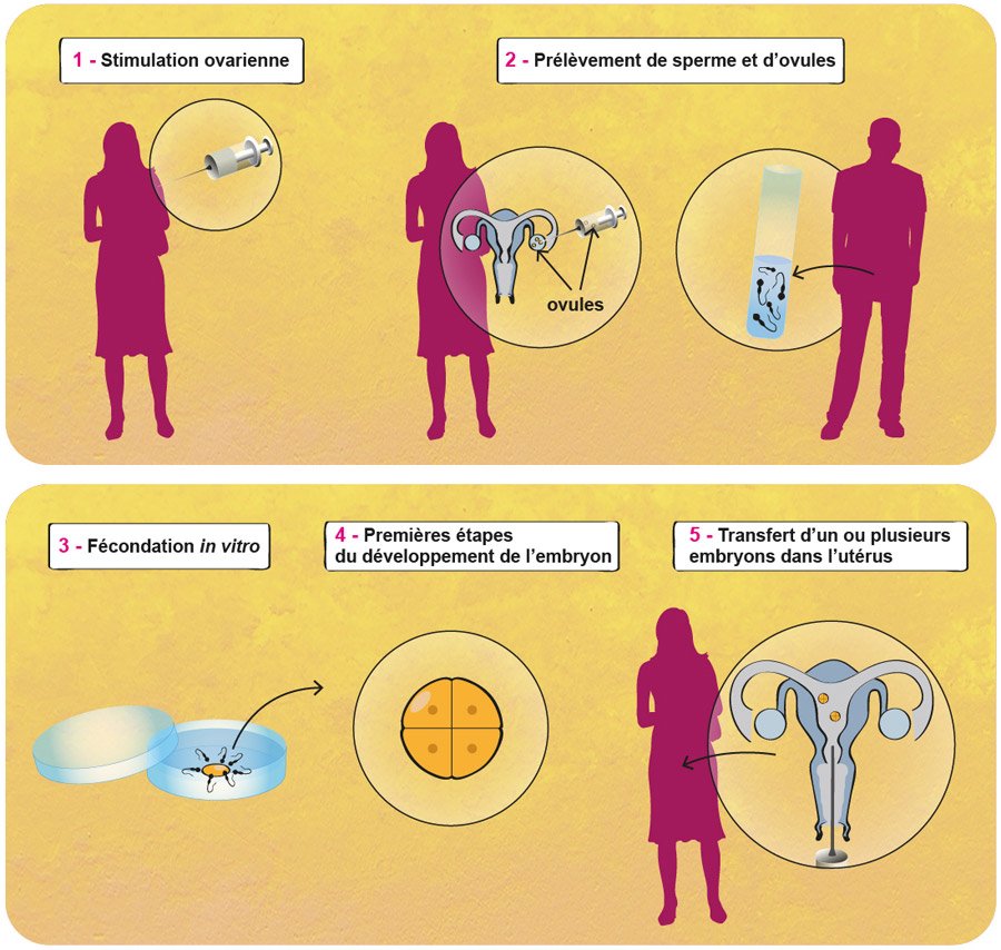 Les étapes de la FIV : 1- Stimulation ovarienne ; 2- Prélèvement de sperme et d'ovules ; 3- Fécondation in vitro ; 4- 1res étapes du développement de l'embryon in vitro ; 5- Transfert d'un ou plusieurs embryons dans l'utérus