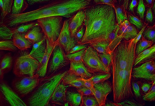 Visualisation de cellules mammaires cancéreuses avec leur morphologie de type fibroblastique (allongée) © Inserm/Fauvet, Frédérique