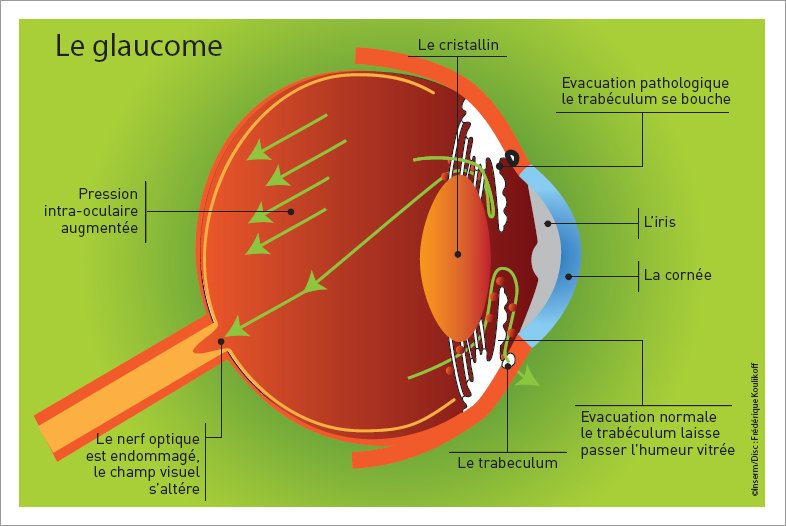 Schéma d'un œil atteint de glaucome : le trabéculum se bouche et la pression intra-occulaire augmente.