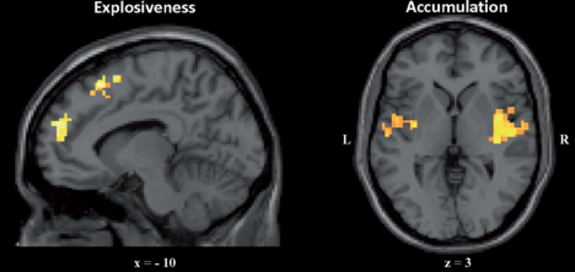 IRM d'un cerveau, vue de coupe et vue de dessus.